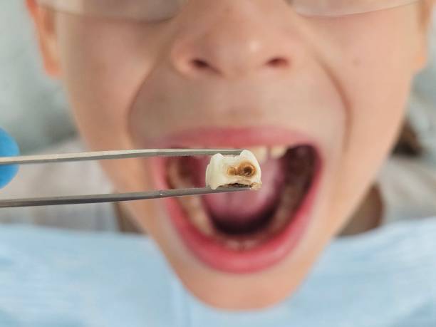 Best Emergency Wisdom Tooth Extraction in Center Point, IA